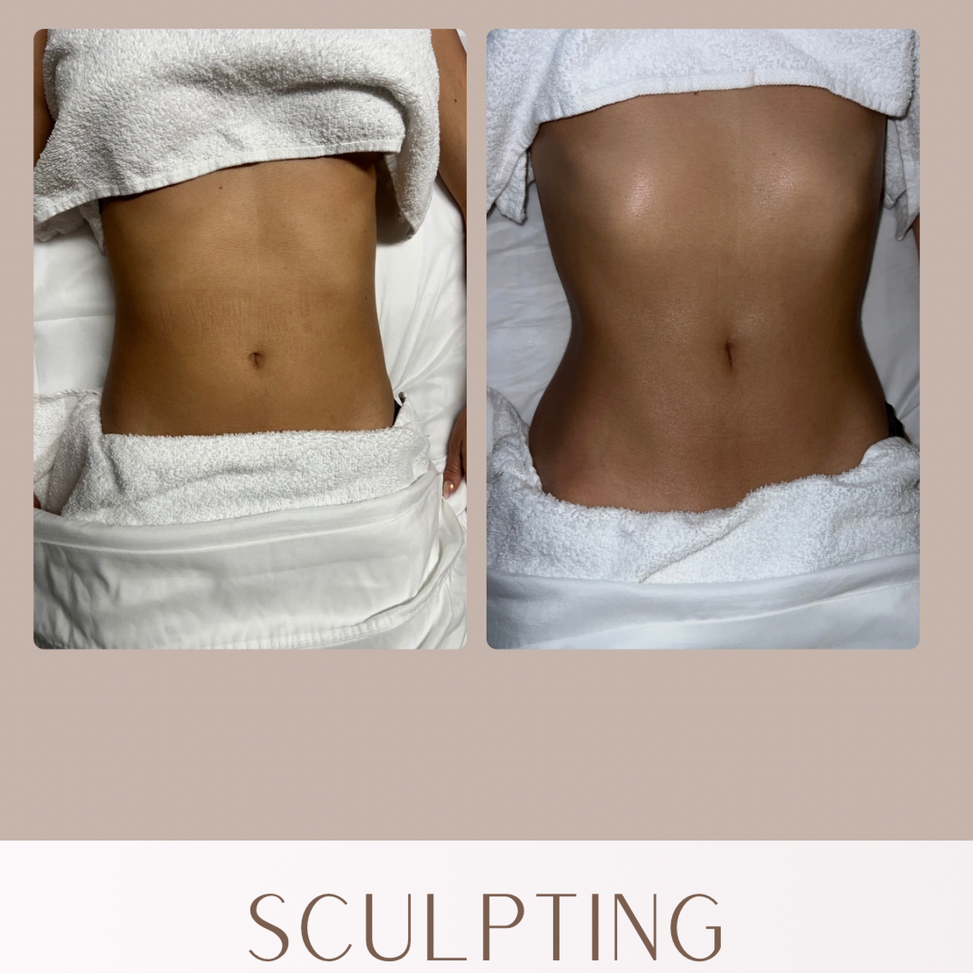Brazilian Body Sculpting 3505 Camino del Rio S Suite 150, San Diego California 92108