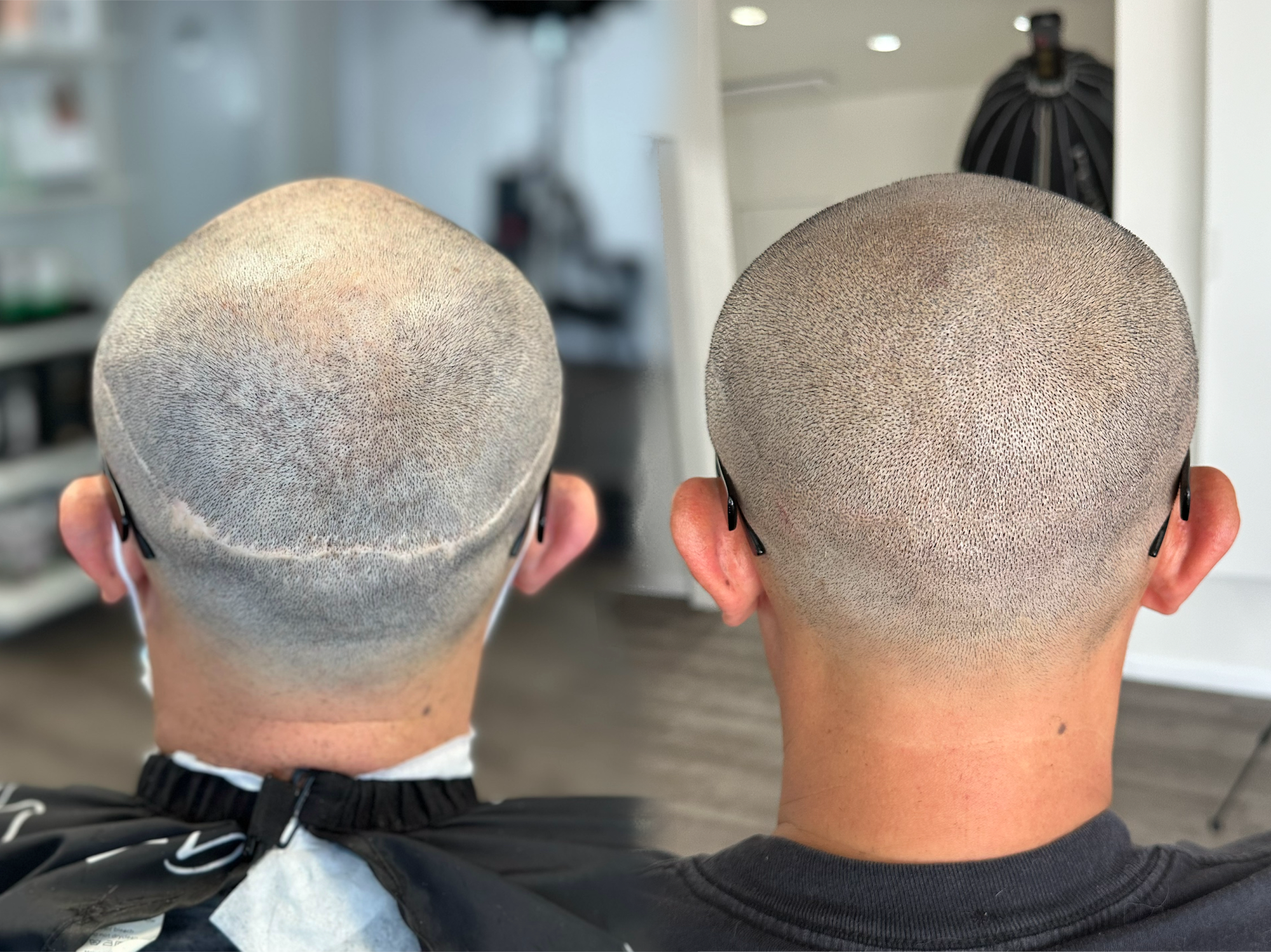 SMP Scalp Micropigmentation CA (SMPCA Academy)