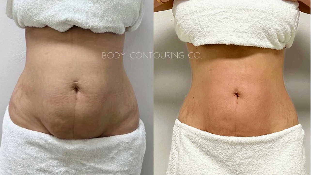 Body Contouring Co. Doral 8180 NW 36th St Suite 101, Doral Florida 33166