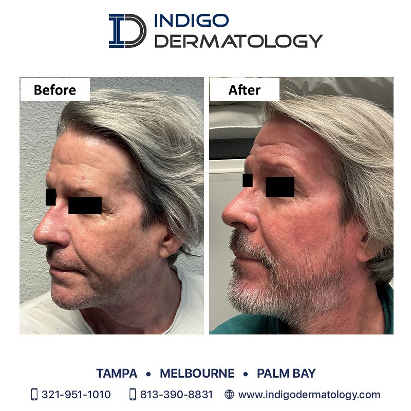 Indigo Dermatology