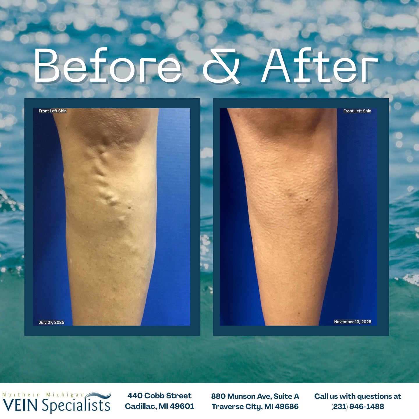 The Vein Clinic of Northern Michigan- Kingsford 800 East Blvd, Kingsford Michigan 49802