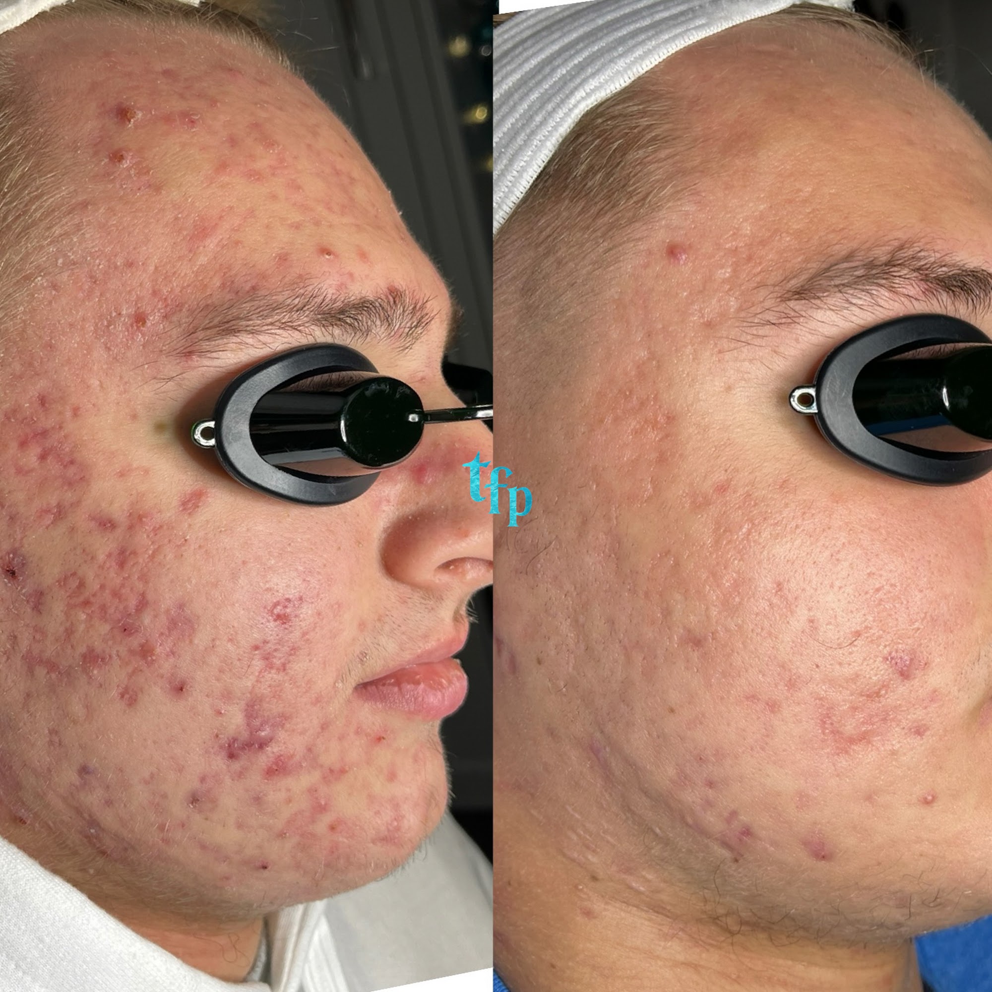 The Face Place Acne + Esthetics