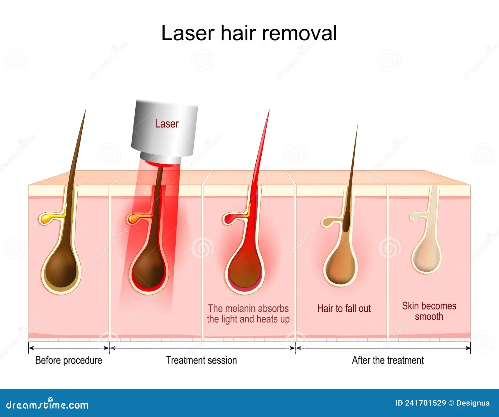 Restorative Laser Therapy