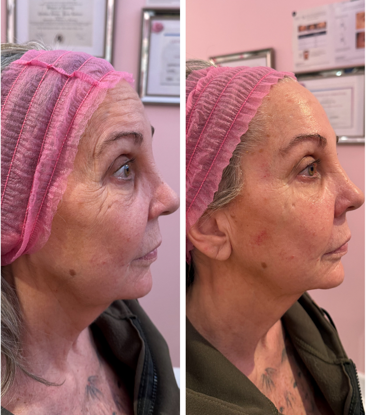 Botox La Belle Peau 20 Via Bel Canto Suite 130, Henderson Nevada 89011