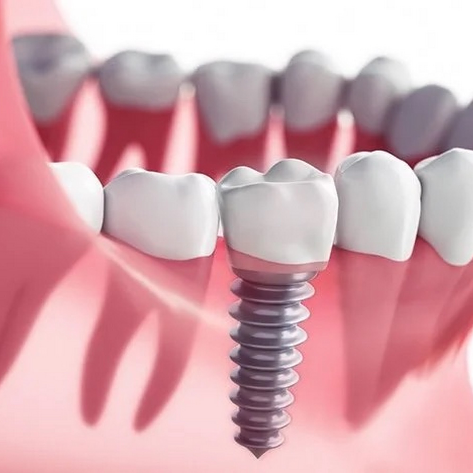 Tooth Implant Dental Queens