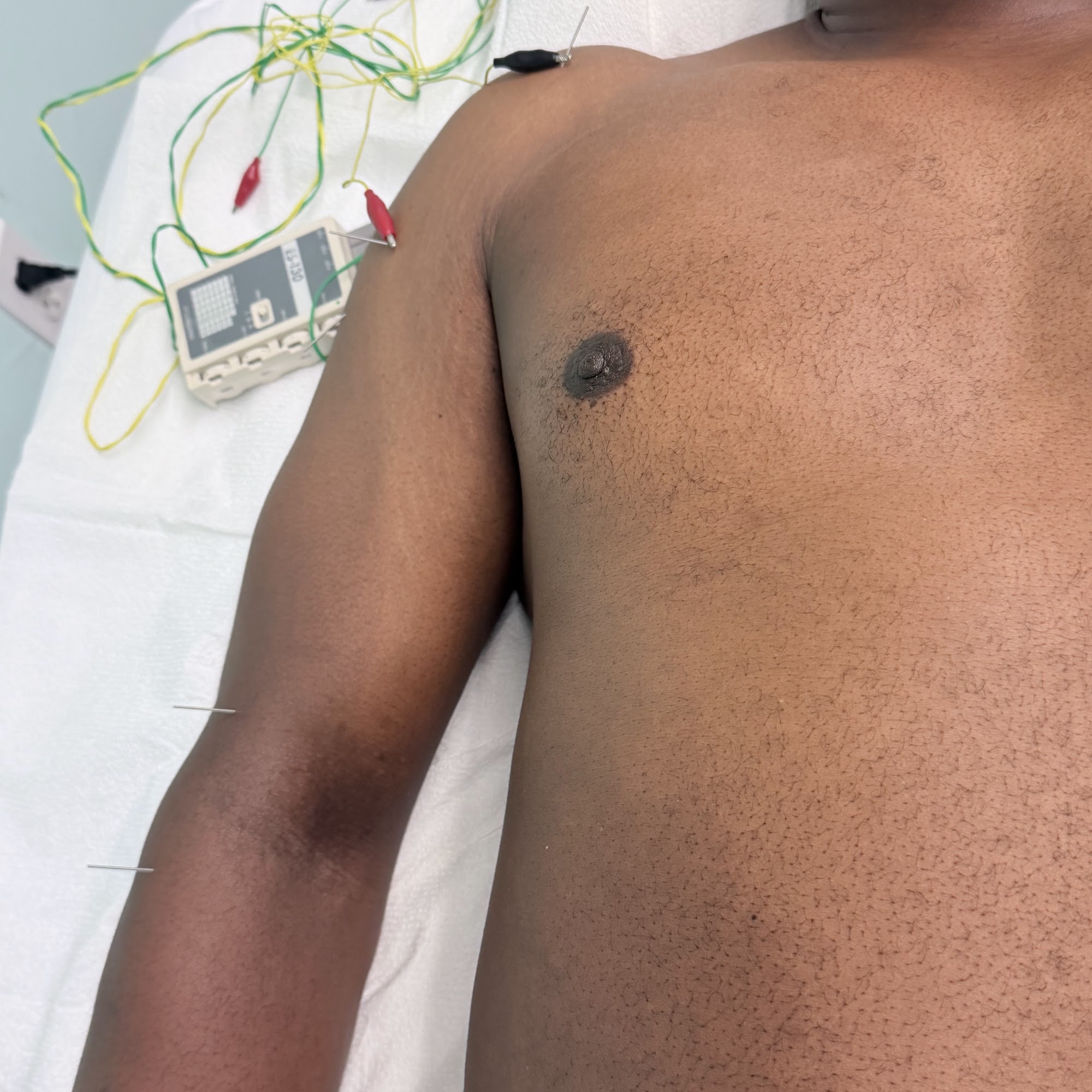 Yaxian Ding Acupuncture