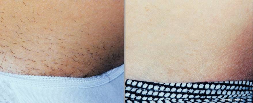 RAD Laser Hair Removal Center of Philadelphia Haverford