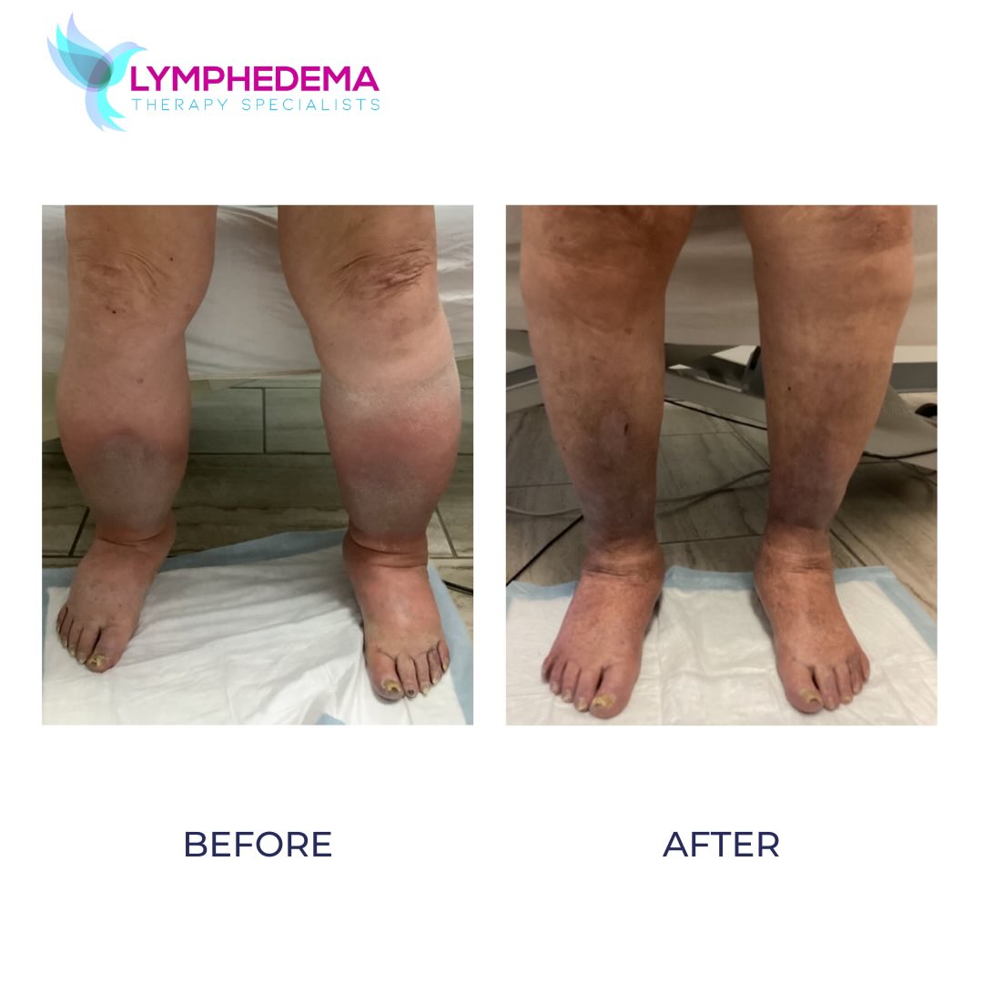 Lymphedema Therapy Specialists | Lymphedema Clinic