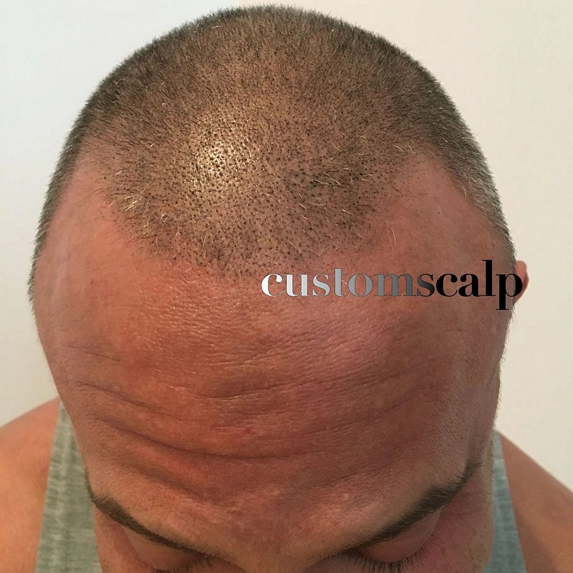 CustomScalp